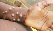 Screening protocol for Mpox at Bengaluru airport soon Screening protocol for Mpox at Bengaluru airport soon